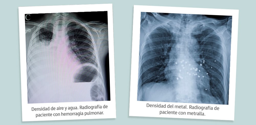 densidad radiológica, niveles de penetración radiológica, radiología simple, radiografía simple